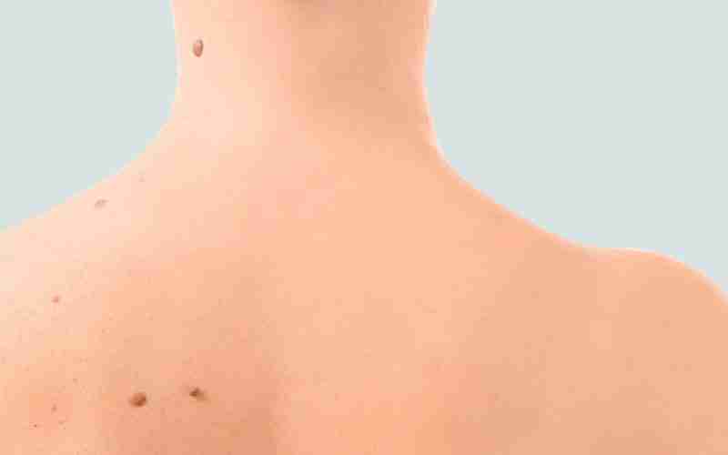 Mole Removal Proven Dermatology Solutions